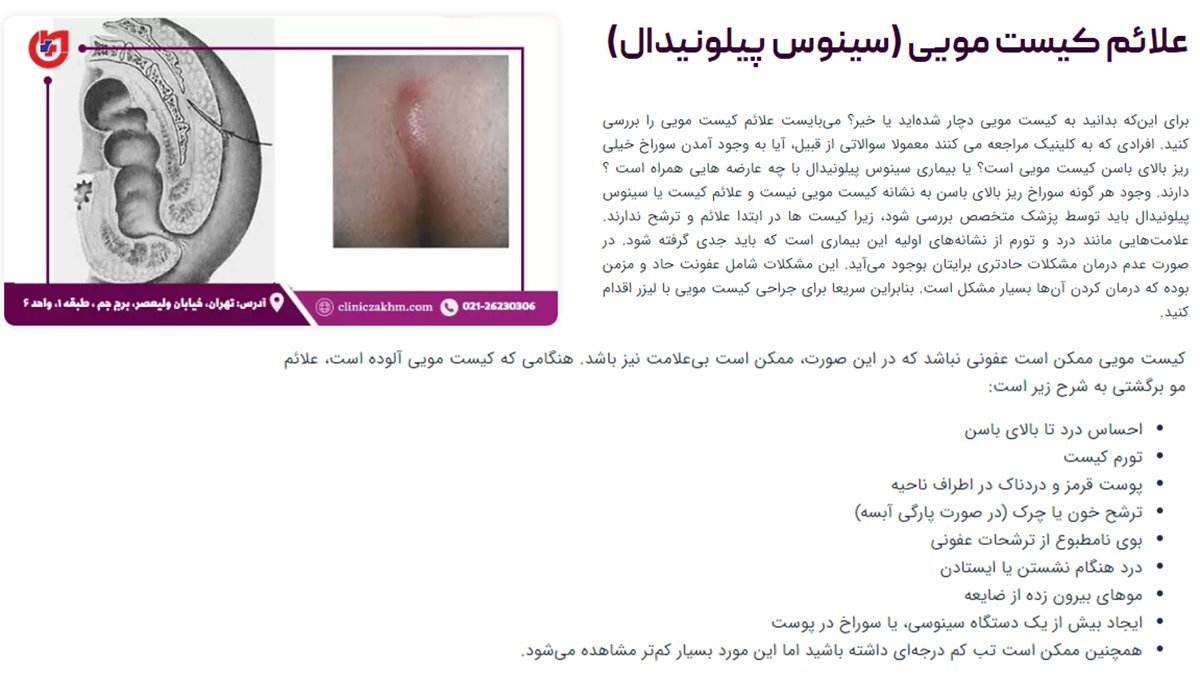 علائم کیست مویی و روش درمان آن با لیزر